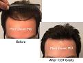 Click image for larger version

Name:	Hair Transplant Slides copy35.001.jpg
Views:	308
Size:	12.8 KB
ID:	477972