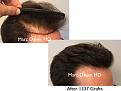 Click image for larger version

Name:	Hair Transplant Slides copy35.003.jpg
Views:	301
Size:	12.8 KB
ID:	477974