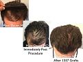 Click image for larger version

Name:	Hair Transplant Slides copy35.004.jpg
Views:	348
Size:	15.5 KB
ID:	477975