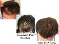 Click image for larger version

Name:	Hair Transplant Slides copy35.004.jpg
Views:	287
Size:	15.5 KB
ID:	477975