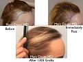 Click image for larger version

Name:	Hair Transplant Slides copy46.001.jpg
Views:	800
Size:	16.4 KB
ID:	477994