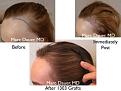 Click image for larger version

Name:	Hair Transplant Slides copy46.002.jpg
Views:	2212
Size:	15.4 KB
ID:	477995