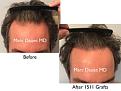 Click image for larger version

Name:	Hair Transplant Slides copy46.006.jpg
Views:	426
Size:	15.0 KB
ID:	477996