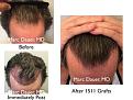 Click image for larger version

Name:	Hair Transplant Slides copy46.005.jpg
Views:	395
Size:	17.9 KB
ID:	477997