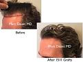 Click image for larger version

Name:	Hair Transplant Slides copy46.004.jpg
Views:	394
Size:	14.0 KB
ID:	477998
