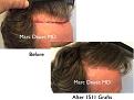 Click image for larger version

Name:	Hair Transplant Slides copy46.003.jpg
Views:	398
Size:	15.8 KB
ID:	477999