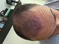 Click image for larger version

Name:	1 month post surgury.jpg
Views:	1078
Size:	92.6 KB
ID:	478007