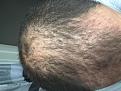 Click image for larger version

Name:	6 weeks post surgury.jpg
Views:	849
Size:	87.9 KB
ID:	478008