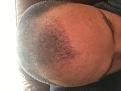 Click image for larger version

Name:	12 weeks post surgury .jpg
Views:	851
Size:	89.4 KB
ID:	478010