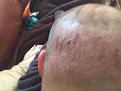 Click image for larger version

Name:	Day after surgury 2.JPG
Views:	757
Size:	74.8 KB
ID:	478017