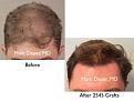 Click image for larger version

Name:	Hair Transplant Slides copy50.001.jpg
Views:	252
Size:	12.5 KB
ID:	478191