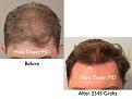 Click image for larger version

Name:	Hair Transplant Slides copy50.001.jpg
Views:	310
Size:	12.5 KB
ID:	478191