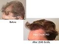 Click image for larger version

Name:	Hair Transplant Slides copy50.002.jpg
Views:	238
Size:	12.1 KB
ID:	478192
