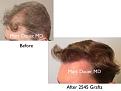 Click image for larger version

Name:	Hair Transplant Slides copy50.002.jpg
Views:	299
Size:	12.1 KB
ID:	478192