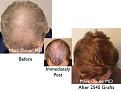 Click image for larger version

Name:	Hair Transplant Slides copy50.004.jpg
Views:	246
Size:	15.4 KB
ID:	478194