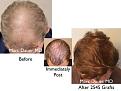 Click image for larger version

Name:	Hair Transplant Slides copy50.004.jpg
Views:	300
Size:	15.4 KB
ID:	478194