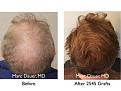 Click image for larger version

Name:	Hair Transplant Slides copy50.005.jpg
Views:	304
Size:	16.1 KB
ID:	478195
