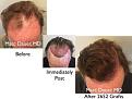 Click image for larger version

Name:	Hair Transplant Slides copy51.004.jpg
Views:	445
Size:	14.1 KB
ID:	478241