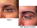 Click image for larger version

Name:	Hair Transplant Slides copy55.003.jpg
Views:	278
Size:	13.6 KB
ID:	478274