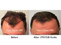 Click image for larger version

Name:	Hair Transplant Slides copy52.001.jpg
Views:	323
Size:	13.6 KB
ID:	478307