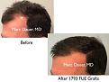 Click image for larger version

Name:	Hair Transplant Slides copy52.002.jpg
Views:	309
Size:	12.7 KB
ID:	478309