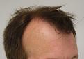 Click image for larger version

Name:	pre-op (3).JPG
Views:	441
Size:	62.3 KB
ID:	478338