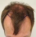 Click image for larger version

Name:	pre-op (5).jpg
Views:	439
Size:	30.8 KB
ID:	478340