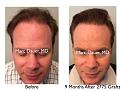Click image for larger version

Name:	Hair Transplant Slides copy50.007.jpg
Views:	367
Size:	16.1 KB
ID:	478360