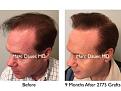 Click image for larger version

Name:	Hair Transplant Slides copy50.006.jpg
Views:	357
Size:	16.5 KB
ID:	478362