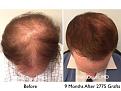 Click image for larger version

Name:	Hair Transplant Slides copy50.009.jpg
Views:	359
Size:	16.8 KB
ID:	478363