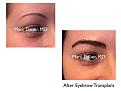 Click image for larger version

Name:	Hair Transplant Slides copy61.005.jpg
Views:	270
Size:	11.1 KB
ID:	478372