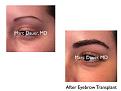 Click image for larger version

Name:	Hair Transplant Slides copy61.006.jpg
Views:	250
Size:	11.2 KB
ID:	478373