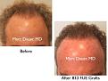Click image for larger version

Name:	Hair Transplant Slides copy45.001.jpg
Views:	448
Size:	13.4 KB
ID:	478433
