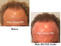 Click image for larger version

Name:	Hair Transplant Slides copy45.001.jpg
Views:	365
Size:	13.4 KB
ID:	478433