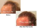 Click image for larger version

Name:	Hair Transplant Slides copy45.002.jpg
Views:	380
Size:	12.7 KB
ID:	478434