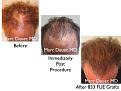 Click image for larger version

Name:	Hair Transplant Slides copy45.004.jpg
Views:	481
Size:	15.3 KB
ID:	478436