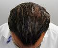 Click image for larger version

Name:	ja 1 year post chin down.jpg
Views:	267
Size:	87.8 KB
ID:	478450