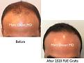 Click image for larger version

Name:	Hair Transplant Slides copy60.001.jpg
Views:	461
Size:	12.3 KB
ID:	478468