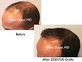 Click image for larger version

Name:	Hair Transplant Slides copy60.002.jpg
Views:	444
Size:	11.8 KB
ID:	478470