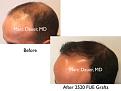 Click image for larger version

Name:	Hair Transplant Slides copy60.002.jpg
Views:	357
Size:	11.8 KB
ID:	478470