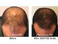 Click image for larger version

Name:	Hair Transplant Slides copy60.004.jpg
Views:	400
Size:	14.7 KB
ID:	478471