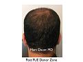 Click image for larger version

Name:	Hair Transplant Slides copy60.006.jpg
Views:	406
Size:	10.3 KB
ID:	478473