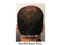 Click image for larger version

Name:	Hair Transplant Slides copy60.006.jpg
Views:	331
Size:	10.3 KB
ID:	478473