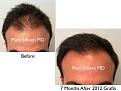 Click image for larger version

Name:	Hair Transplant Slides copy63.001.jpg
Views:	435
Size:	13.1 KB
ID:	478540