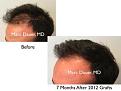 Click image for larger version

Name:	Hair Transplant Slides copy63.002.jpg
Views:	401
Size:	12.5 KB
ID:	478542