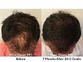 Click image for larger version

Name:	Hair Transplant Slides copy63.004.jpg
Views:	413
Size:	16.6 KB
ID:	478543