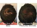 Click image for larger version

Name:	Hair Transplant Slides copy63.005.jpg
Views:	317
Size:	16.8 KB
ID:	478544