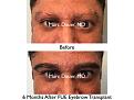 Click image for larger version

Name:	Hair Transplant Slides copy65.001.jpg
Views:	298
Size:	14.5 KB
ID:	478614
