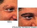 Click image for larger version

Name:	Hair Transplant Slides copy65.002.jpg
Views:	282
Size:	16.8 KB
ID:	478615