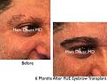 Click image for larger version

Name:	Hair Transplant Slides copy65.002.jpg
Views:	199
Size:	16.8 KB
ID:	478615